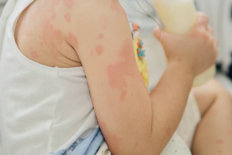 Alergia a la proteína de la leche.