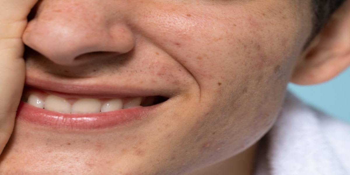 relacion-lacteos-acne